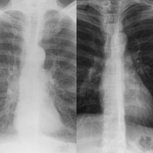 Lung X-Rays from FB 4 years after quitting.jpg Lung X-Rays from FB 4 years after quitting.jpg