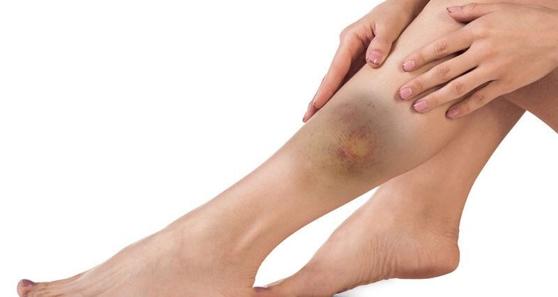 leg-contusion800-800x426.jpg