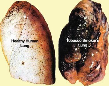 lungs(1).jpg