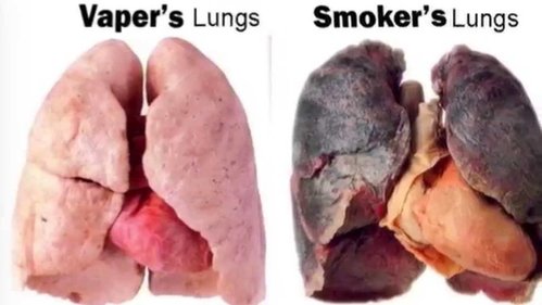 Vapers lung.jpg