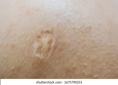 scarring-on-skin-vaccination-260nw-1675790251.jpg