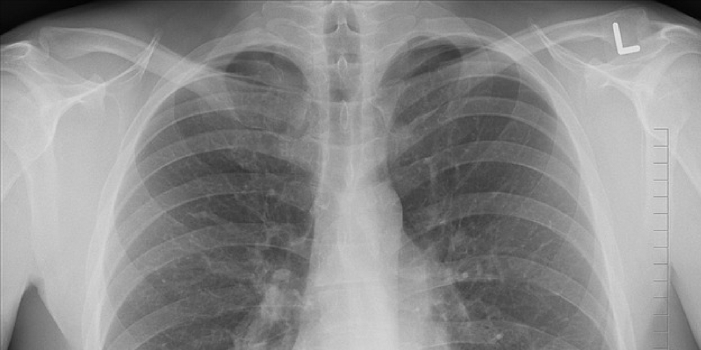 lungs-vaping.jpg